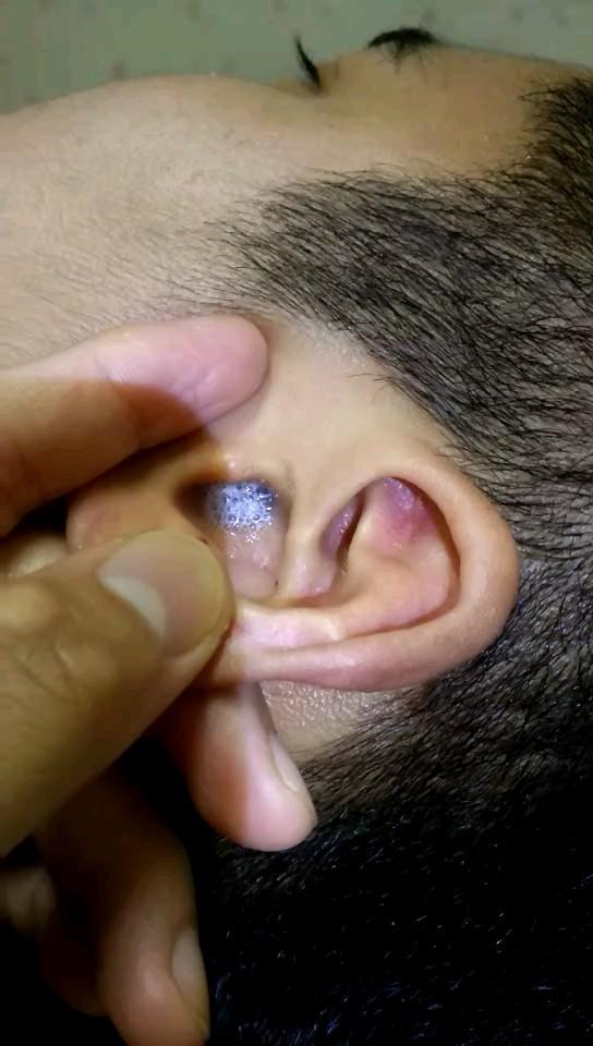 师承鄂派采耳 从业9年 技术精湛 采耳洗眼取耳