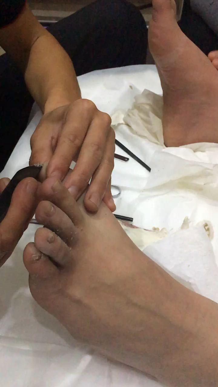 修脚 去除脚上的角质死皮 对治疗脚病也非常的